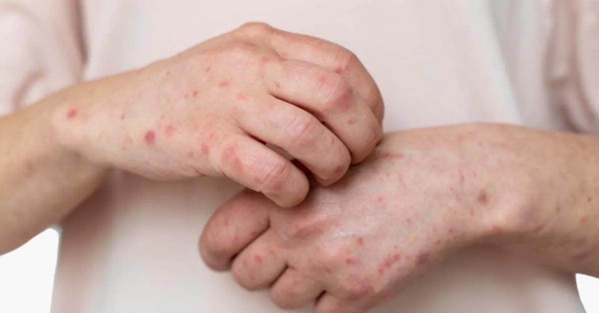 Post Inflammatory Rash Post Inflammatory Erythema Understanding | Iberiaskinbrands.in