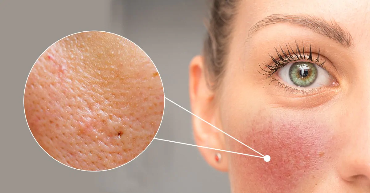 Understanding Orange Peel Skin